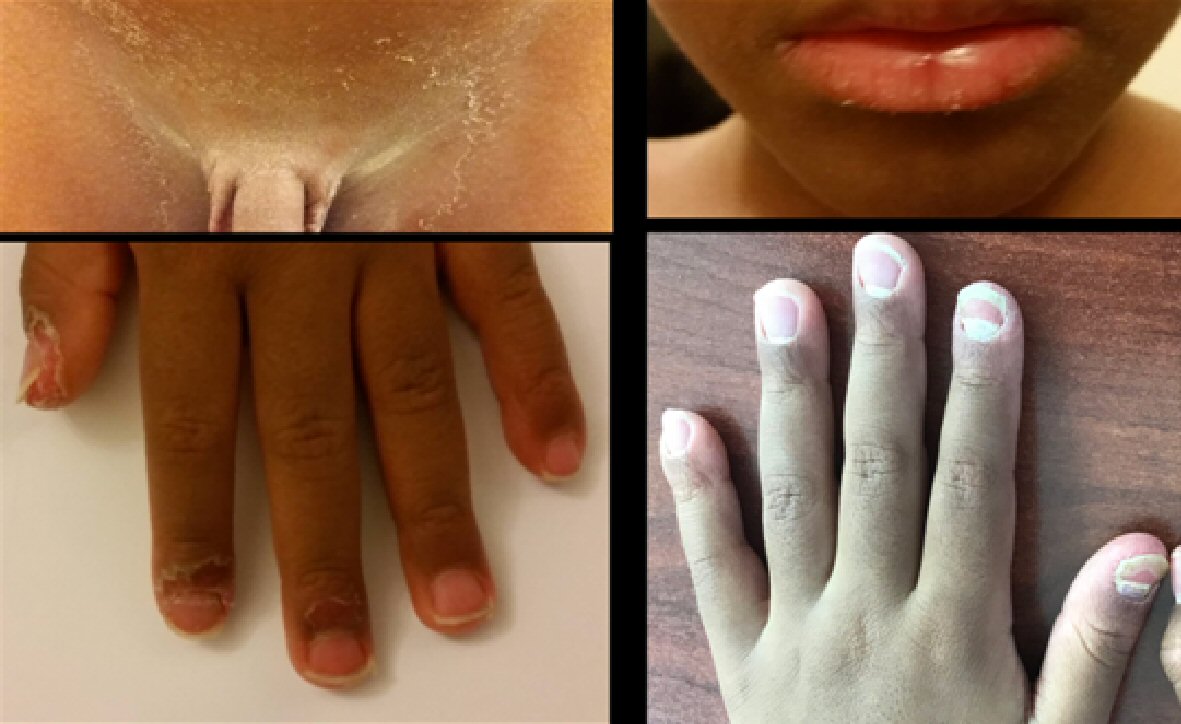 Onycholysis (Nail Separation): Symptoms, Causes & Treatment